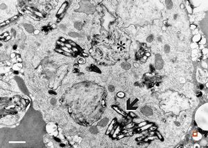 Whipple disease Whipple disease